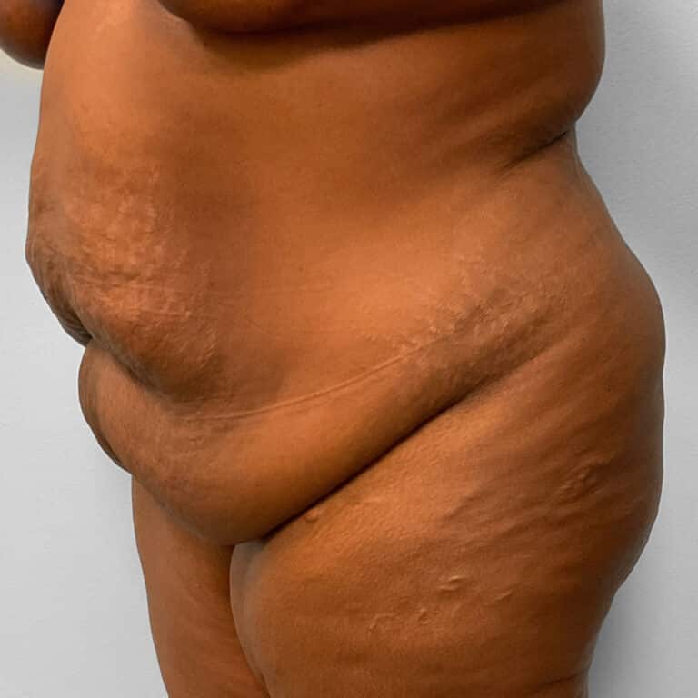 Before Image: Abdominoplasty & Lipo – Dr. Tucker - left-front-oblique
