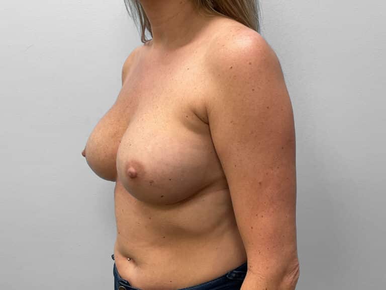 Before Image: Breast Implant Exchange- Dr. Tucker - left-front-oblique