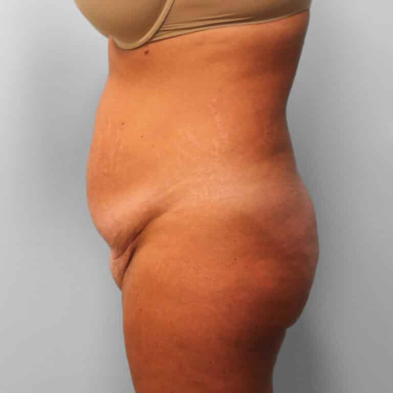 Before Image: Tummy Tuck & Lipo – Dr. Tucker - left-side