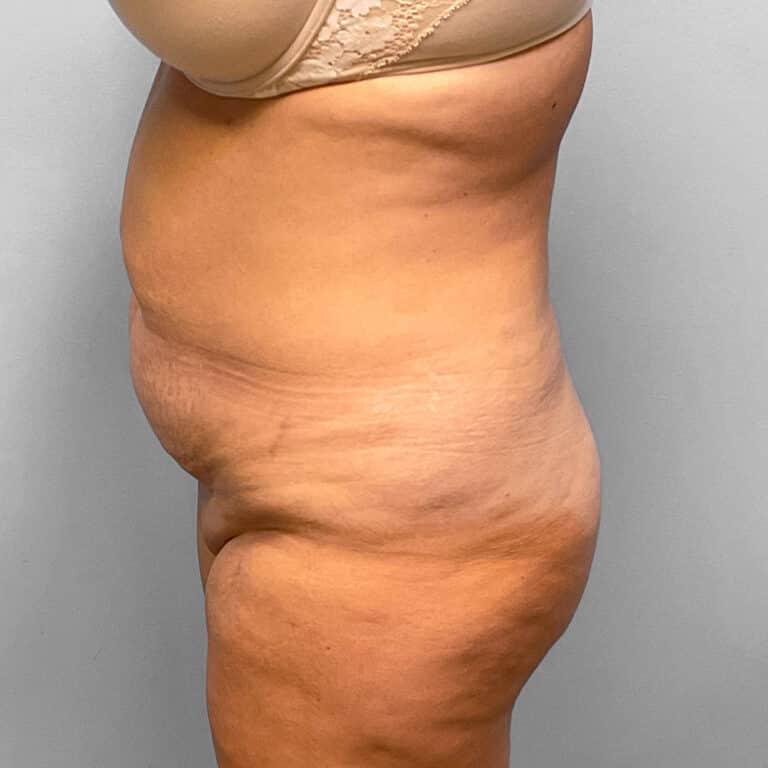 Before Image: Abdominoplasty & Lipo – Dr. Tucker - left-side