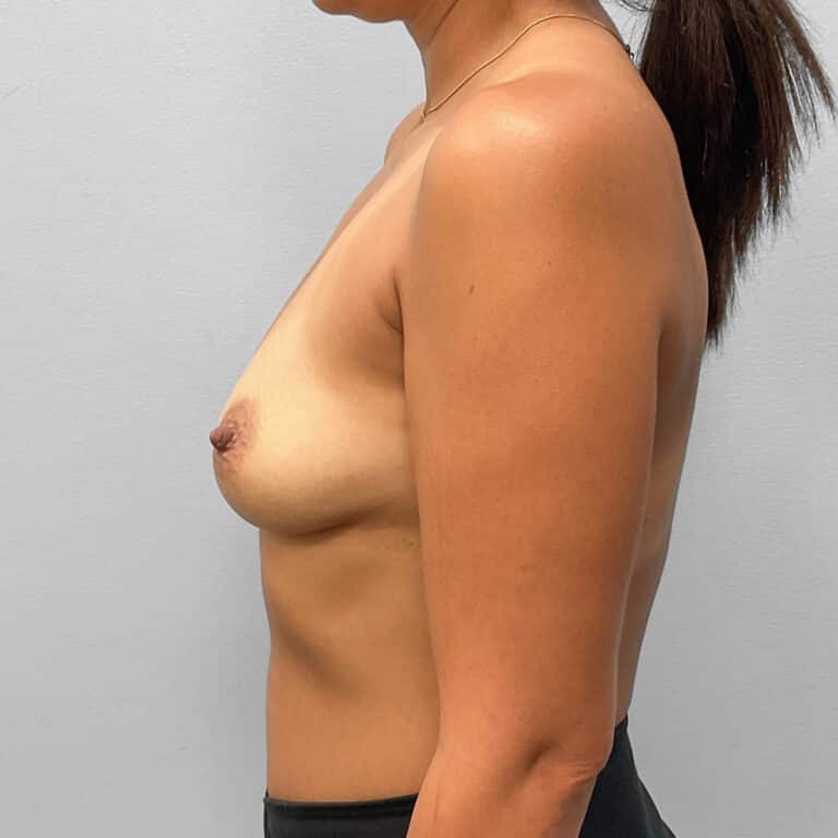 Before Image: Breast Augmentation- Dr. Tucker - left-side