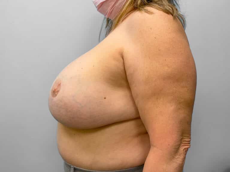 Before Image: Breast Lift & Implant Removal – Dr. Tucker - left-side