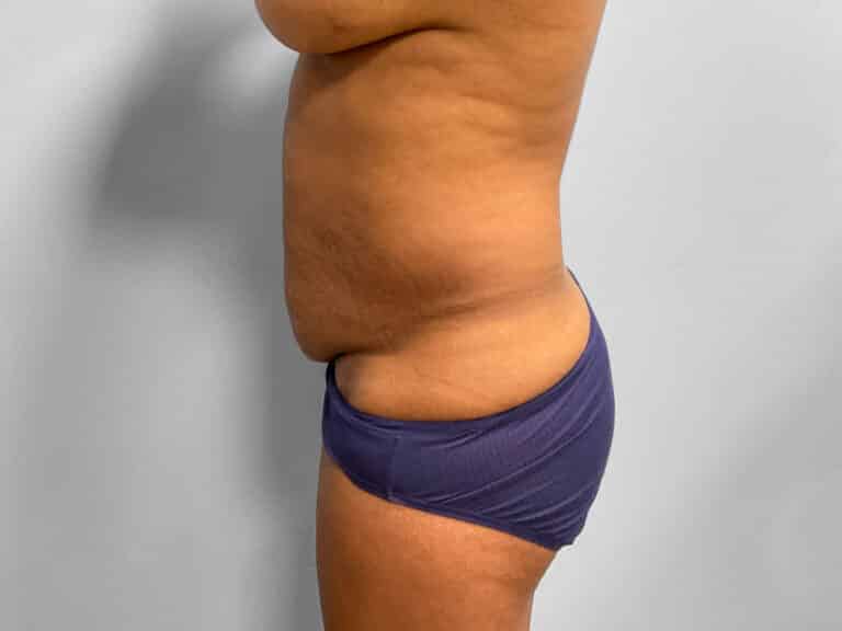 Before Image: Tummy Tuck & Lipo – Dr. Tucker - left-side