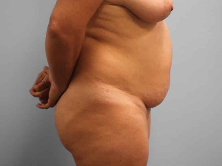 Before Image: Tummy Tuck – Dr. Tucker - right-side