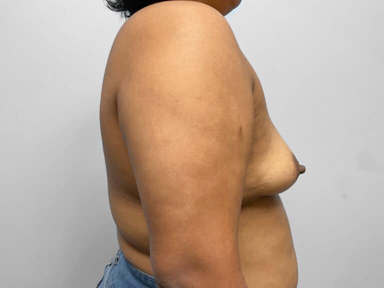 Before Image: Breast Augmentation- Dr. Tucker - right-side