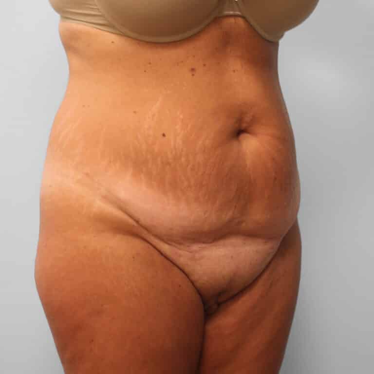Before Image: Tummy Tuck & Lipo – Dr. Tucker - right-front-oblique