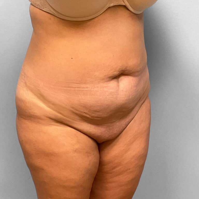 Before Image: Abdominoplasty & Lipo – Dr. Tucker - right-front-oblique