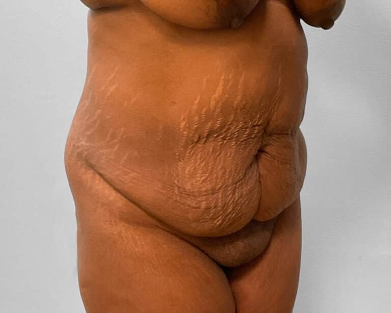 Before Image: Tummy Tuck & Lipo – Dr. Tucker - right-front-oblique