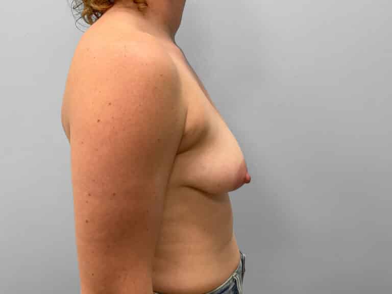 Before Image: Breast Augmentation- Dr. Tucker - right-side