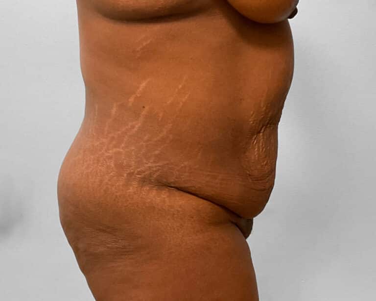 Before Image: Tummy Tuck & Lipo – Dr. Tucker - right-side