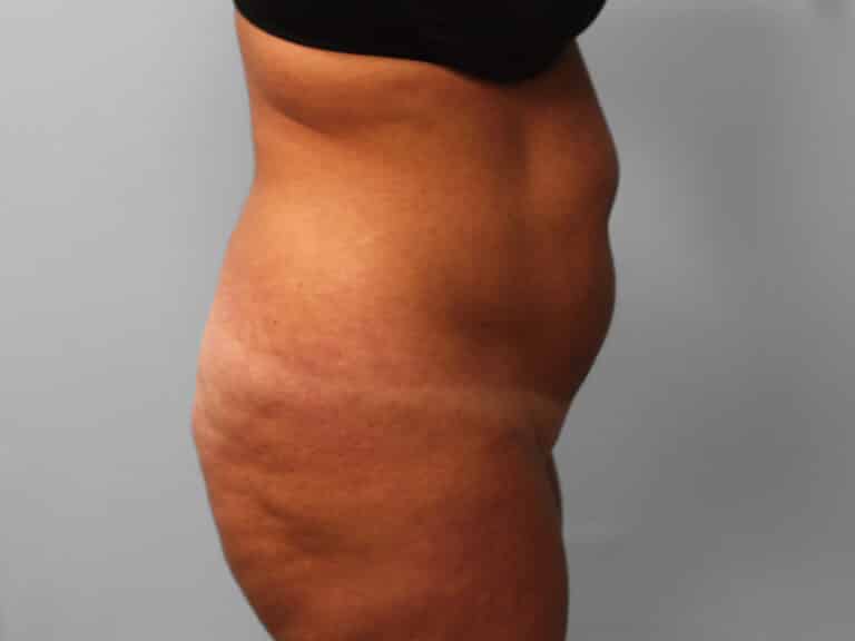 Before Image: Abdominoplasty & Lipo – Dr. Tucker - right-side
