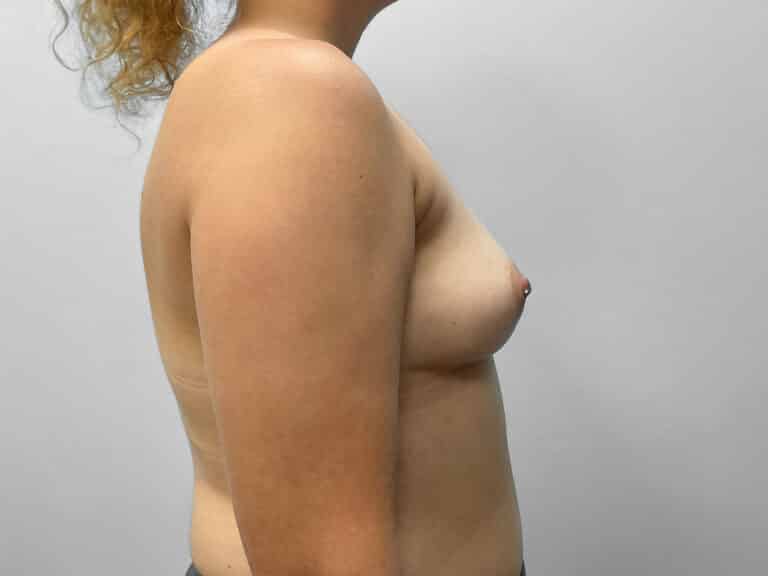 Before Image: Breast Augmentation- Dr. Tucker - right-side