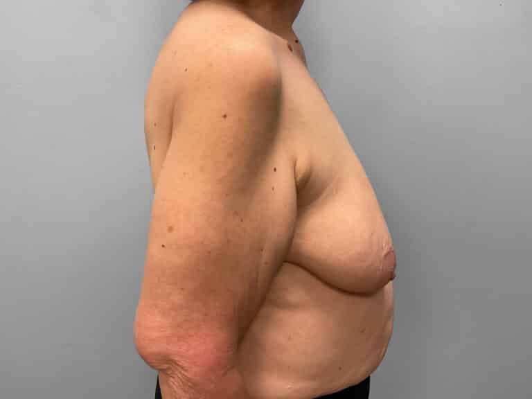 Before Image: Breast Augmentation & Lift – Dr. Tucker - right-side