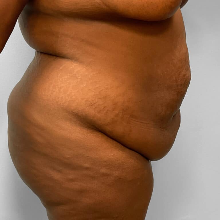Before Image: Abdominoplasty & Lipo – Dr. Tucker - right-side