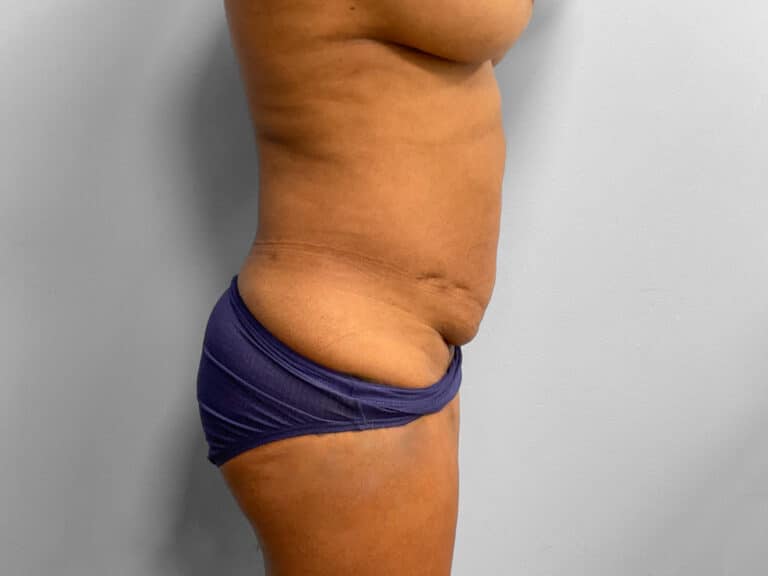 Before Image: Tummy Tuck & Lipo – Dr. Tucker - right-side