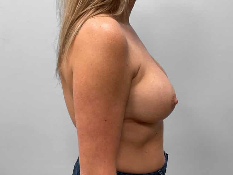 Before Image: Breast Implant Exchange- Dr. Tucker - right-side