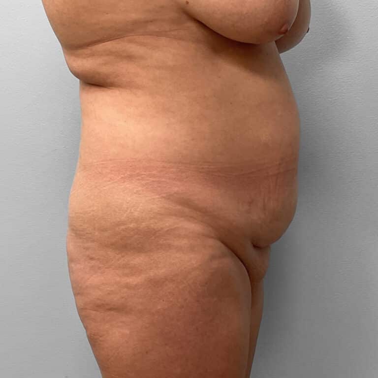 Before Image: Tummy Tuck & Lipo – Dr. Tucker - right-side