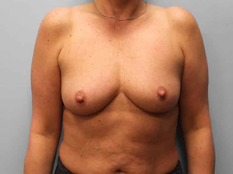 Before Image: Breast Augmentation – Dr. Tucker - front