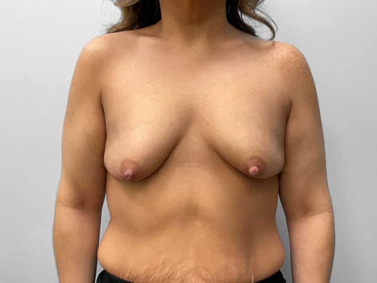 Before Image: Breast Augmentation – Dr. Tucker - front
