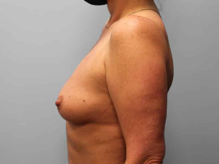 Before Image: Breast Augmentation – Dr. Tucker - left-side