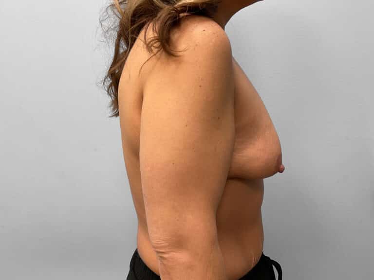 Before Image: Breast Augmentation – Dr. Tucker - right-side
