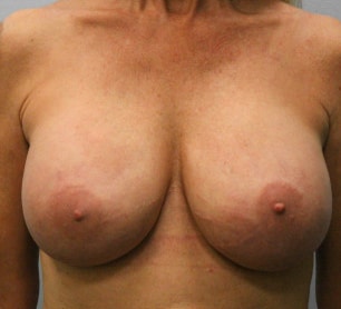 After Image: Breast Augmentation Revision – Dr. Tucker - front