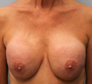 Before Image: Breast Augmentation Revision – Dr. Tucker - front