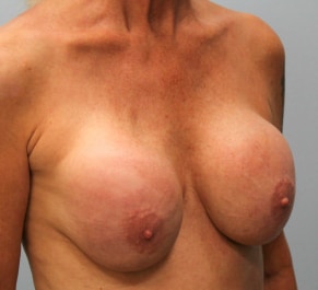 Before Image: Breast Augmentation Revision – Dr. Tucker - right-front-oblique