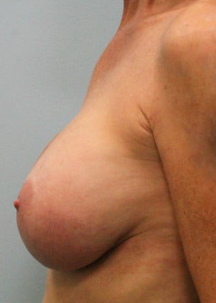 After Image: Breast Augmentation Revision – Dr. Tucker - left-side