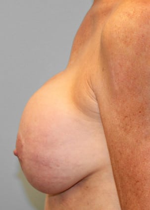 Before Image: Breast Augmentation Revision – Dr. Tucker - left-side