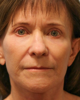 After Image: Facelift & Blepharoplasty – Dr. Howell - front