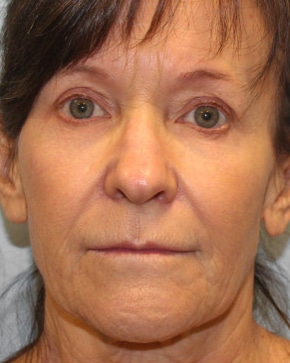 Before Image: Facelift & Blepharoplasty – Dr. Howell - front