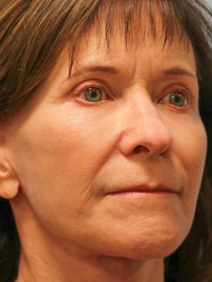 After Image: Facelift & Blepharoplasty – Dr. Howell - right-front-oblique