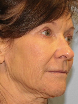 Before Image: Facelift & Blepharoplasty – Dr. Howell - right-front-oblique