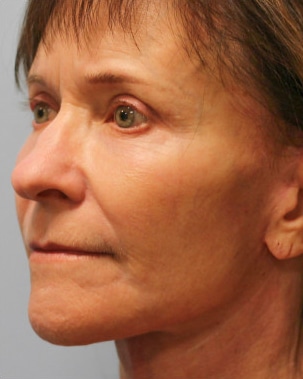 After Image: Facelift & Blepharoplasty – Dr. Howell - left-front-oblique