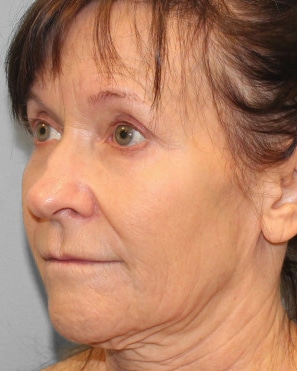 Before Image: Facelift & Blepharoplasty – Dr. Howell - left-front-oblique