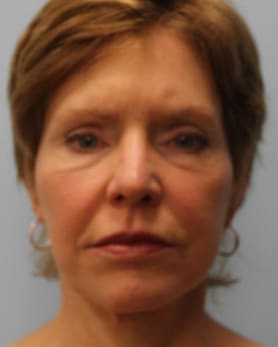After Image: Facelift – Dr. Howell - front