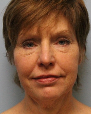 Before Image: Facelift – Dr. Howell - front