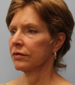After Image: Facelift – Dr. Howell - other