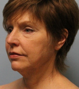 Before Image: Facelift – Dr. Howell - other