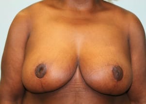 After Image: Breast Reduction – Dr. Howell - front