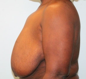Before Image: Breast Reduction – Dr. Howell - left-side