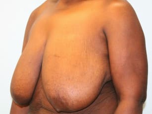 Before Image: Breast Reduction – Dr. Howell - left-front-oblique