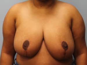 After Image: Breast Reduction – Dr. Tucker - front