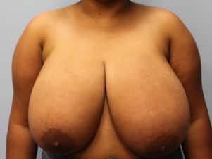 Before Image: Breast Reduction – Dr. Tucker - front