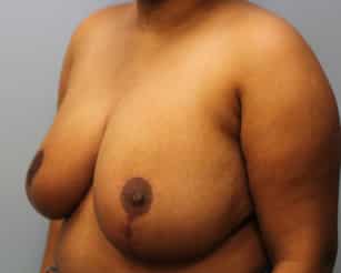 After Image: Breast Reduction – Dr. Tucker - left-front-oblique