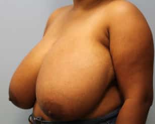 Before Image: Breast Reduction – Dr. Tucker - left-front-oblique
