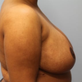 After Image: Breast Reduction – Dr. Tucker - right-side
