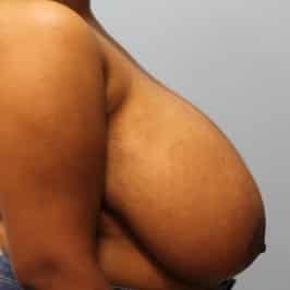 Before Image: Breast Reduction – Dr. Tucker - right-side