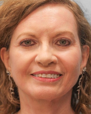After Image: Facelift – Dr. Tucker - front